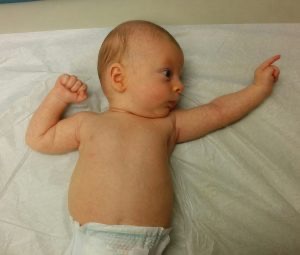 An infant's head is turned to the left, with one arm reaching towards its ear and the other arm pointing away from its body